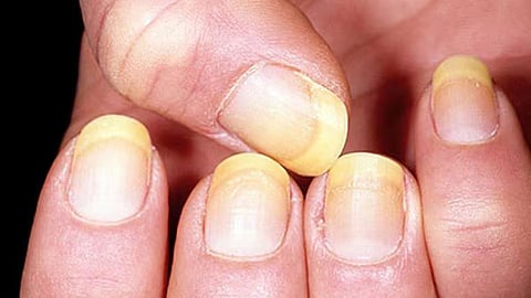 Causes and solutions for nail fungus infection