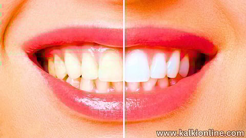 Ways to remove stubborn stains on teeth!