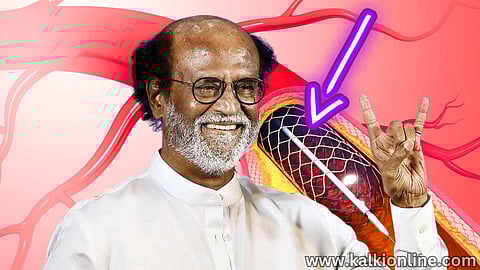 A stent implanted in Rajini's body.