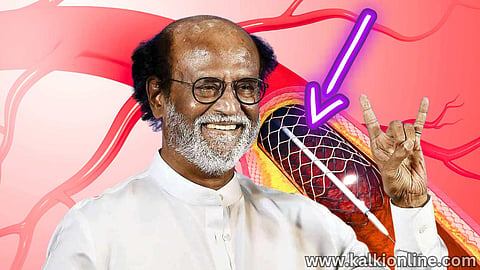 A stent implanted in Rajini's body.