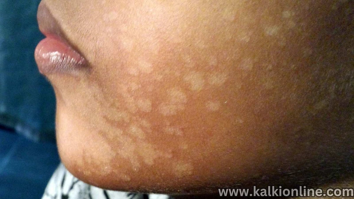 தேமல் பற்றி தெரிந்து கொள்வோம்! 