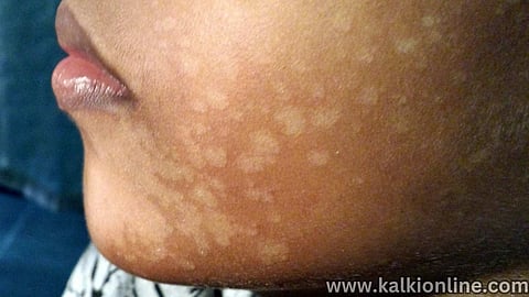 Home Remedies to Get Rid From Themal.