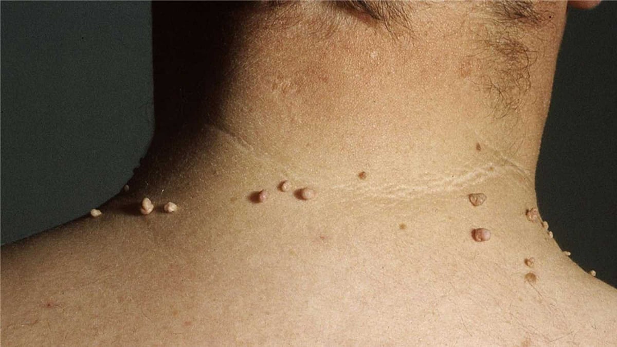 மருக்களை நீக்க உதவும் 5 வீட்டு வைத்திய முறைகள்!