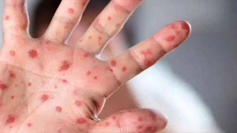 Monkey Pox