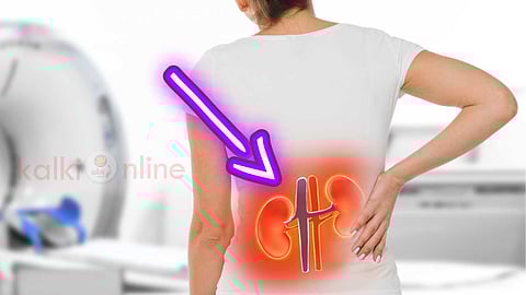 Kidney Cyst