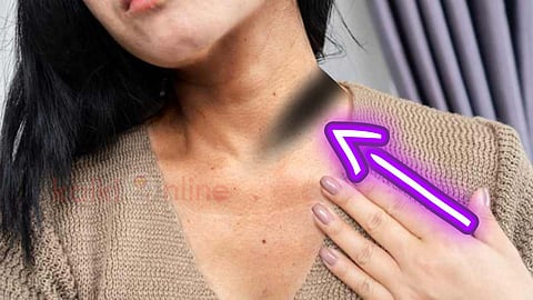 Black neck due to chain