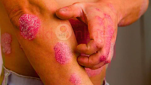 psoriasis