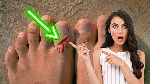 Toe wound