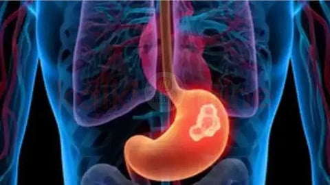 Signs that indicate a tumor in the stomach!