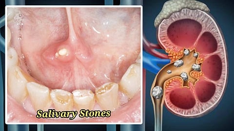 Salivary Stones 