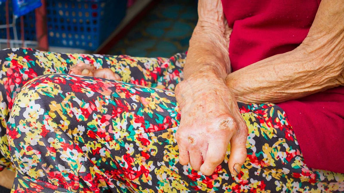 தொழு நோய் ஒரு தொற்று நோயா? அதைத் தடுக்க வழிகள் உண்டா?