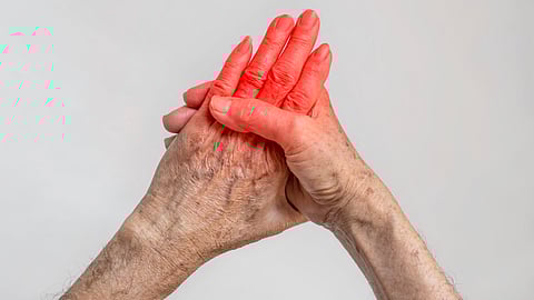 Rheumatoid Arthritis