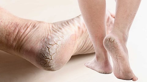 Heel cracks