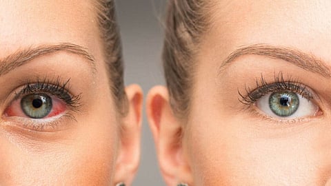 glaucoma 