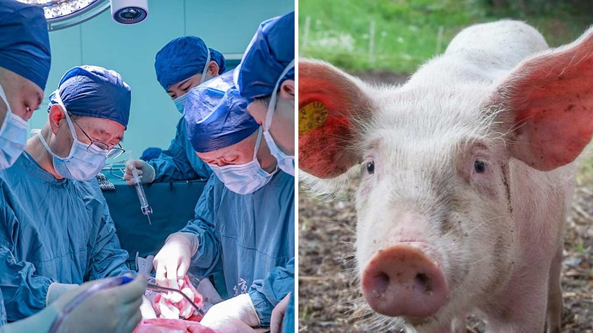 உலகில் முதல் முறையாக மனிதனுக்கு பன்றியின் கல்லீரல் பொருத்தி சாதனை!