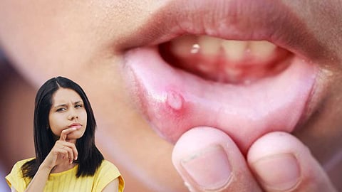 Mouth  Cyst