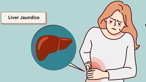 Liver Jaundice