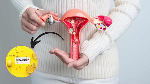 Uterine fibroid