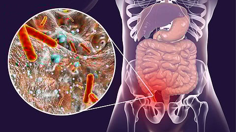 Appendicitis