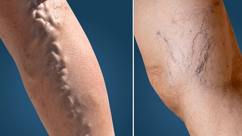 Varicose veins symptoms