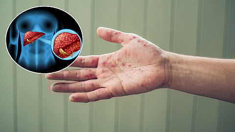 Liver disease is visible in the hands