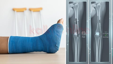 Fracture and rechargeable plate