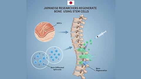 Stem cell therapy regenerating spinal bone fractures