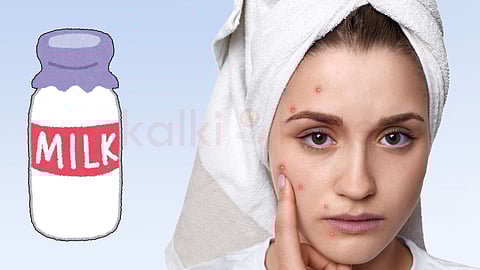 acne and milk