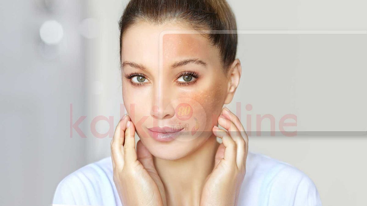 மங்கு (Melasma) மறைய நிரந்தர தீர்வு: வீட்டு வைத்தியங்களும் பராமரிப்பு வழிகளும்!