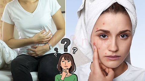 Pimples and stomach problem