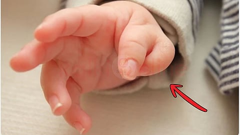  polydactyly: Six fingers in hand