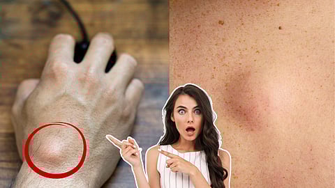 Fatty lump under skin