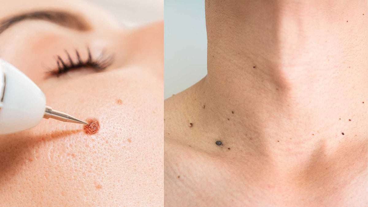 முகத்தில் மருக்களா? நிரந்தரமாக நீக்க இதோ சில டிப்ஸ்!