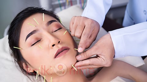 A woman received acupuncture treatment