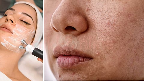 Dark spots disappear tips