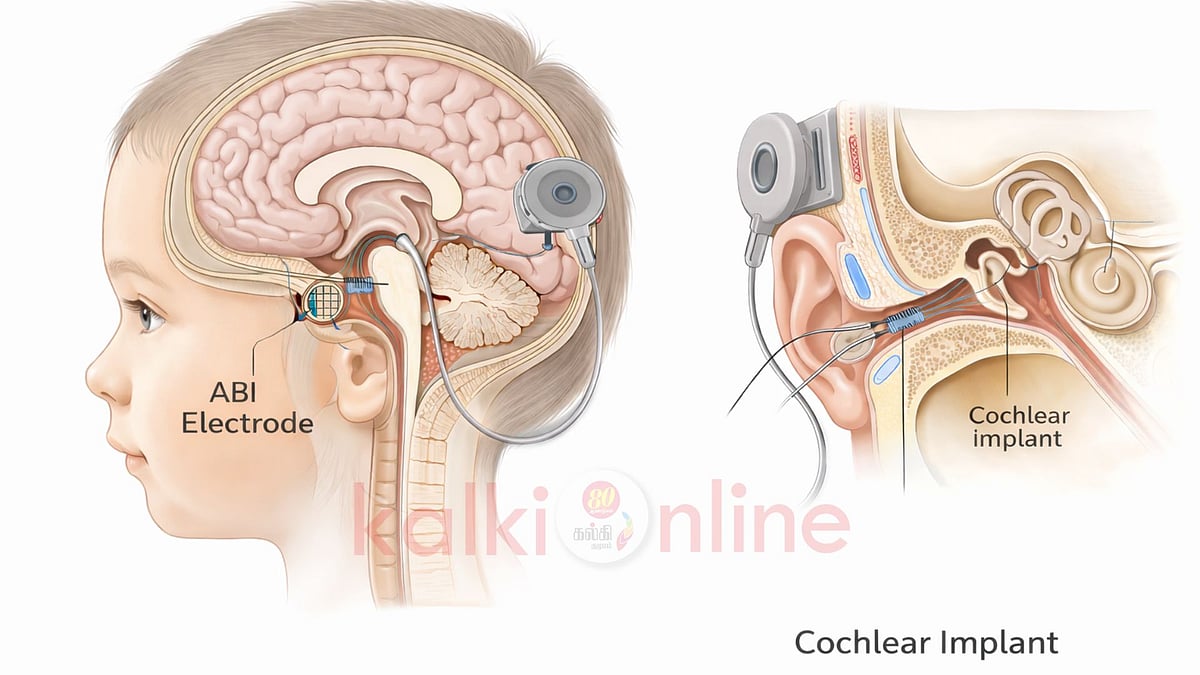 'ABI' சிகிச்சை: உள் காது நரம்பு இல்லாவிட்டாலும் காது கேட்கும்! மருத்துவ உலகின் அதிசயம்! 