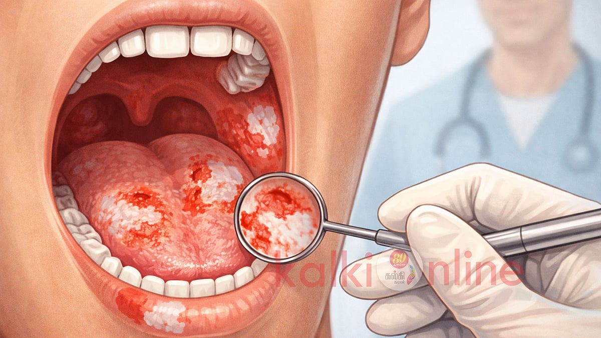 ஓரல் கேன்சர்: வாயில் மறைந்திருக்கும் ஆபத்து!