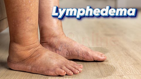Lymphedema | நிணநீர் வீக்கம்