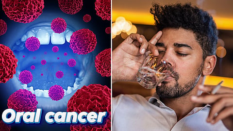  Oral cancer - வாய் புற்றுநோய்