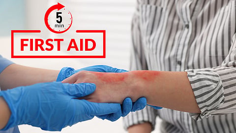 First aid for burns - தீக்காய முதலுதவி