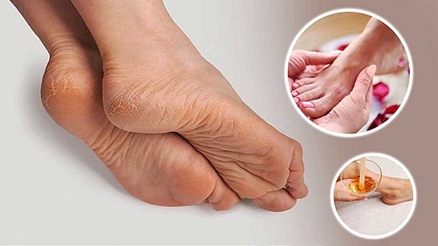 How to protect feet? Here are 3 simple foot packs!