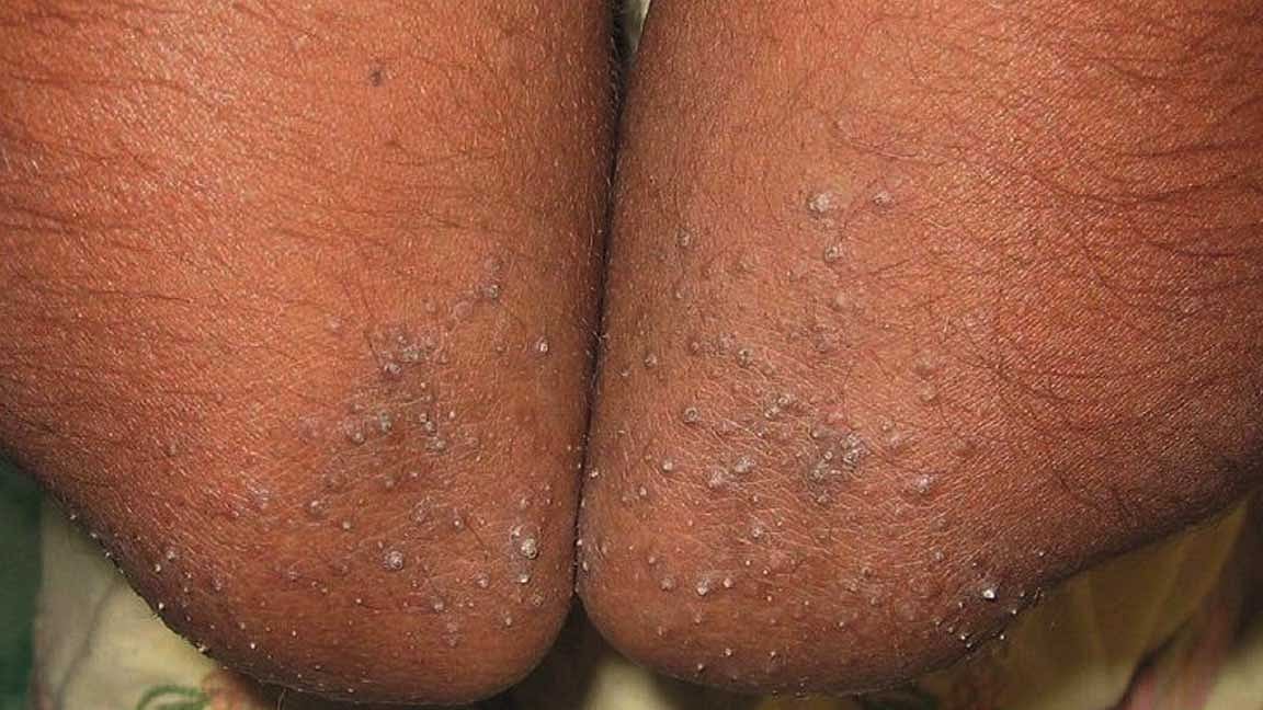 Do you know what frog rash or jackfruit rash is?