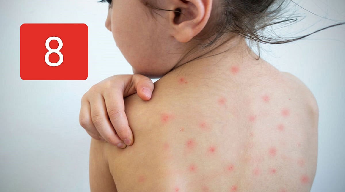 கோடைக்கால அம்மை நோயிலிருந்து காக்கும் 8 ஆலோசனைகள்! 8 Tips to Avoid ...