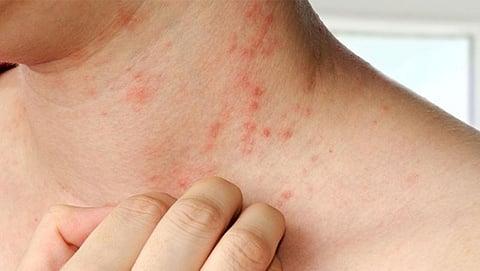 ಚರ್ಮದ ಸಮಸ್ಯೆ 'ಇಸುಬು': ಇಲ್ಲಿದೆ ಕೆಲ ಮನೆಮದ್ದುಗಳು