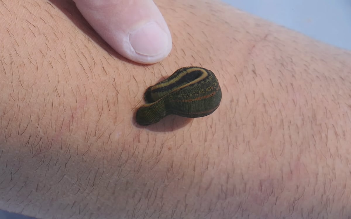 Working Leech Leech Therapy in Kashmir: Ancient Practice Meets Modern Medicine