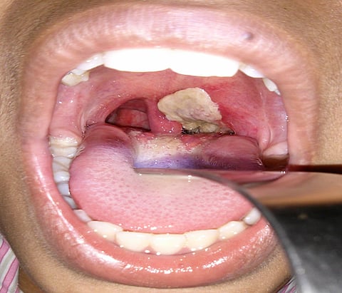 Diphtheria Infected Patient