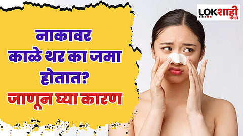 Blackheads on Face : ब्लॅकहेड्समुळे सौंदर्य कमी; जाणून घ्या नाकावर काळे थर का जमा होतात?