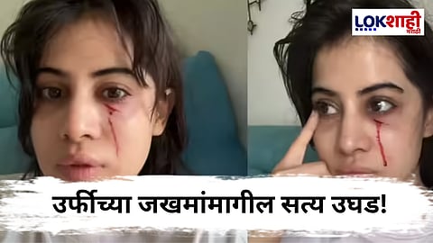 Urfi Javed : चेहऱ्यावर रक्ताचे डाग आणि डोळ्याखाली सूज
