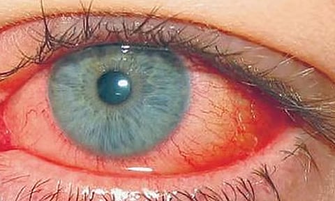 ‘மெட்ராஸ் ஐ’- வெப்ப அலையில் இருந்து பாதுகாக்கும் வழிமுறைகள்