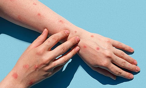 குரங்கு அம்மை தொற்றும்... தடுப்பு நடவடிக்கைகளும்